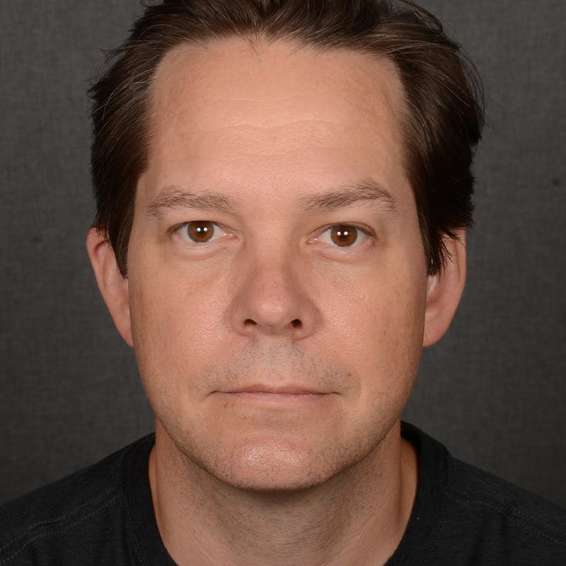 Chin Augmentation Before & After Gallery - Patient 104242 - Image 1