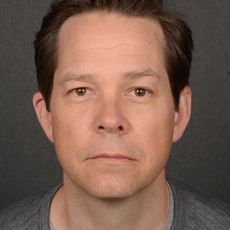 Chin Augmentation Before & After Gallery - Patient 104242 - Image 2