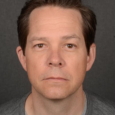 Chin Augmentation Before & After Gallery - Patient 104242 - Image 2