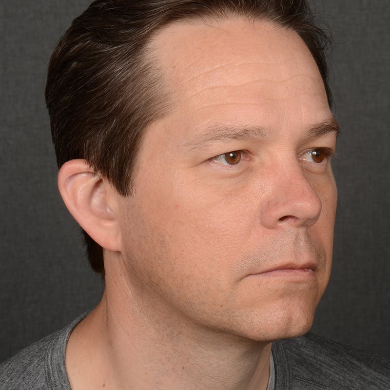 Chin Augmentation Before & After Gallery - Patient 104242 - Image 4