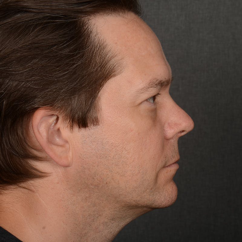 Chin Augmentation Before & After Gallery - Patient 104242 - Image 5
