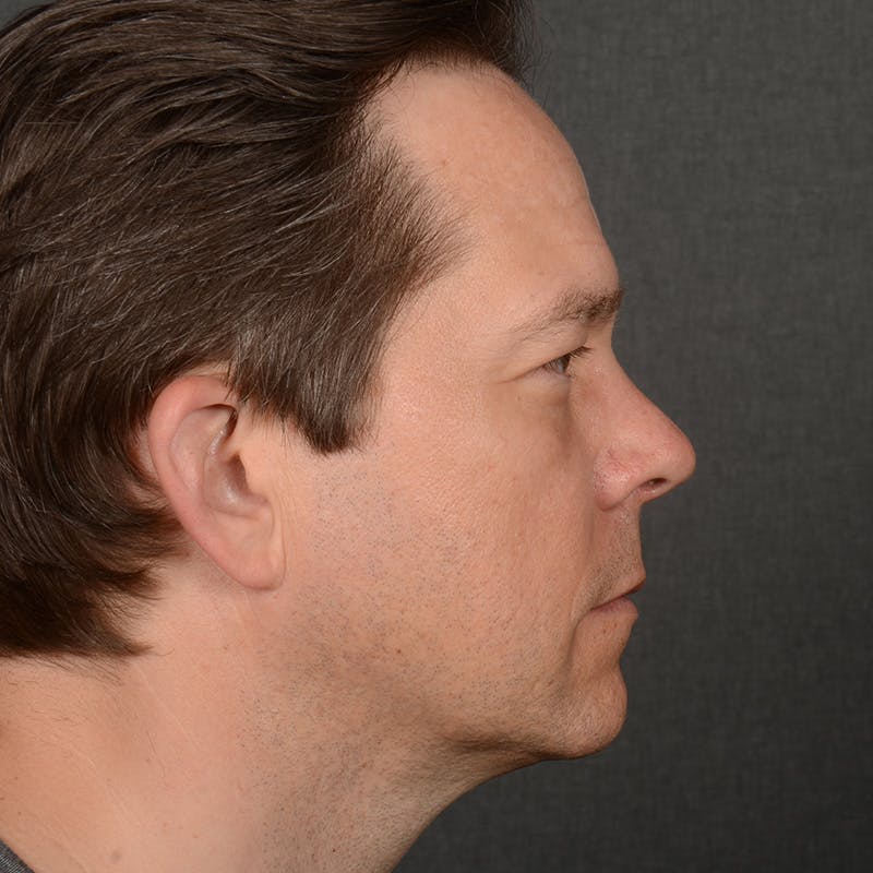 Chin Augmentation Before & After Gallery - Patient 104242 - Image 6