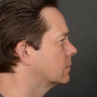 Chin Augmentation Before & After Gallery - Patient 104242 - Image 6