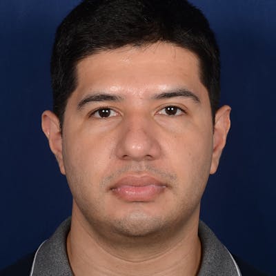 Male Rhinoplasty Before & After Gallery - Patient 373856 - Image 1