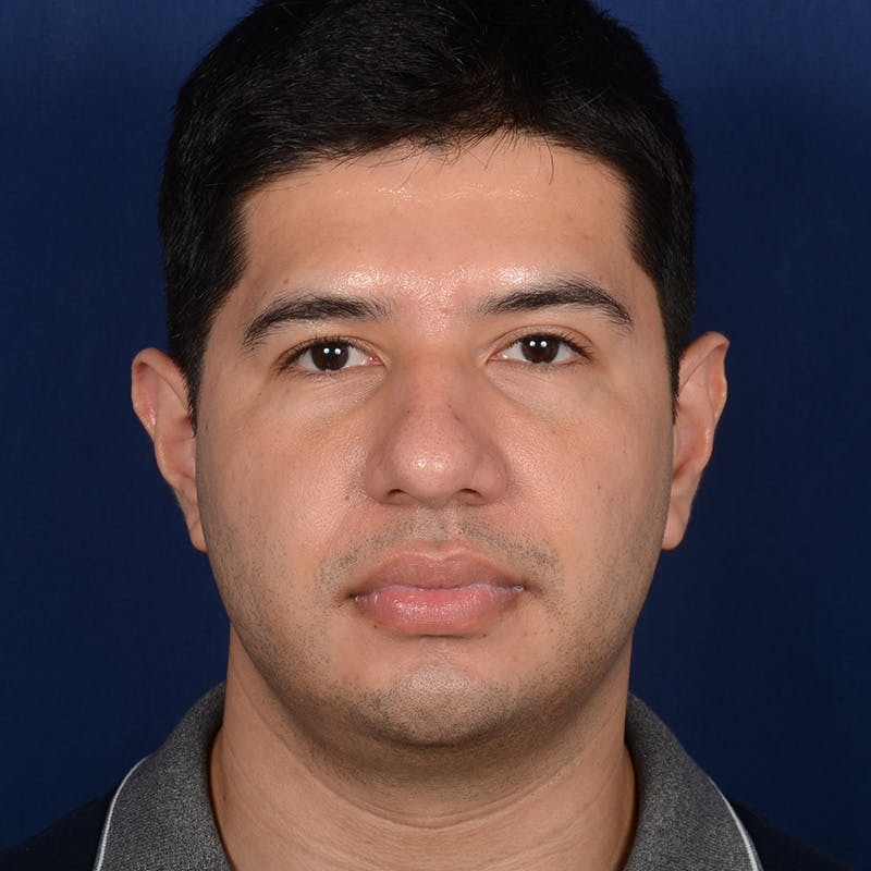 Rhinoplasty w/ Chin Implant Before & After Gallery - Patient 174525 - Image 1