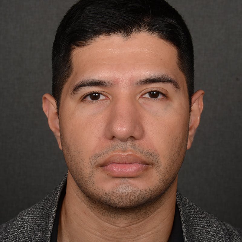 Rhinoplasty w/ Chin Implant Before & After Gallery - Patient 174525 - Image 2