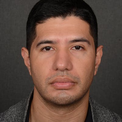 Chin Augmentation Before & After Gallery - Patient 167332 - Image 2