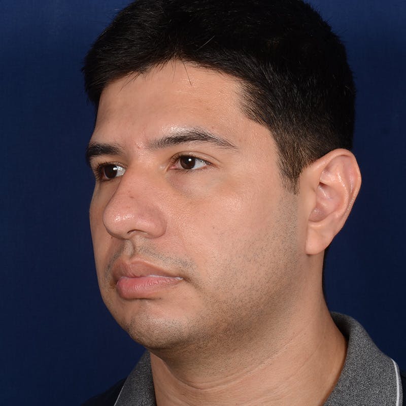Rhinoplasty w/ Chin Implant Before & After Gallery - Patient 174525 - Image 3