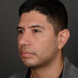 Rhinoplasty w/ Chin Implant Before & After Gallery - Patient 174525 - Image 4