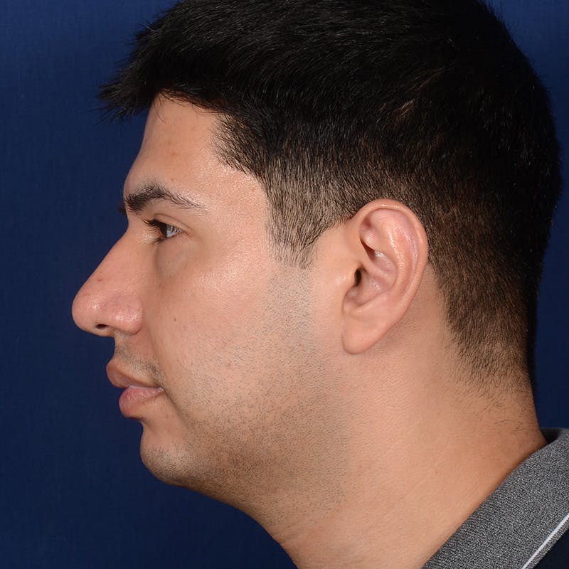 Rhinoplasty w/ Chin Implant Before & After Gallery - Patient 174525 - Image 5