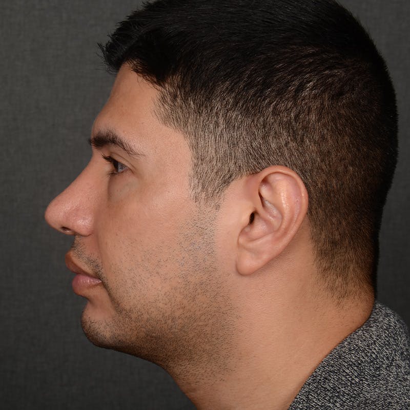 Rhinoplasty w/ Chin Implant Before & After Gallery - Patient 174525 - Image 6