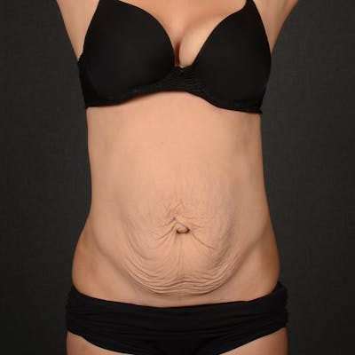 Tummy Tuck Before & After Gallery - Patient 555176 - Image 1
