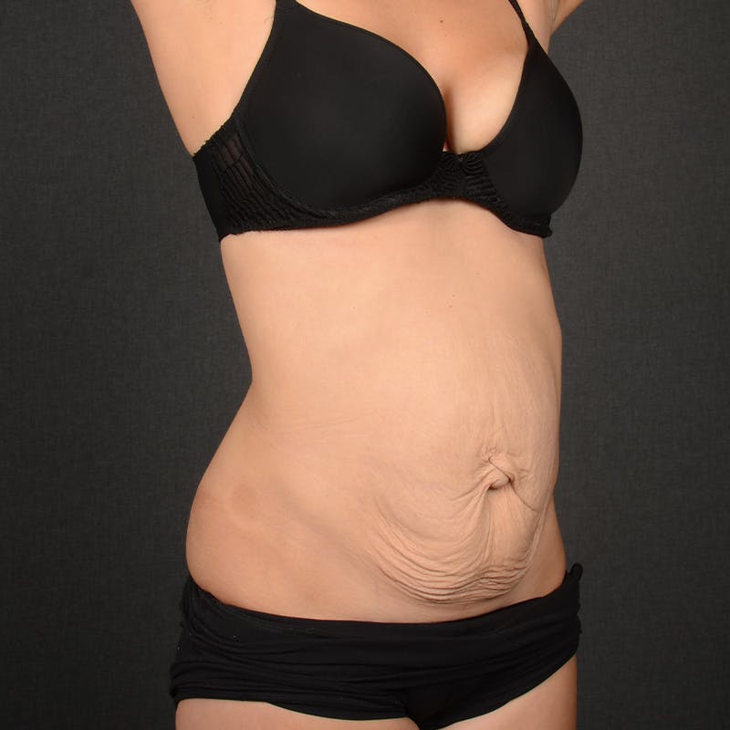 Tummy Tuck Before & After Gallery - Patient 243383 - Image 3
