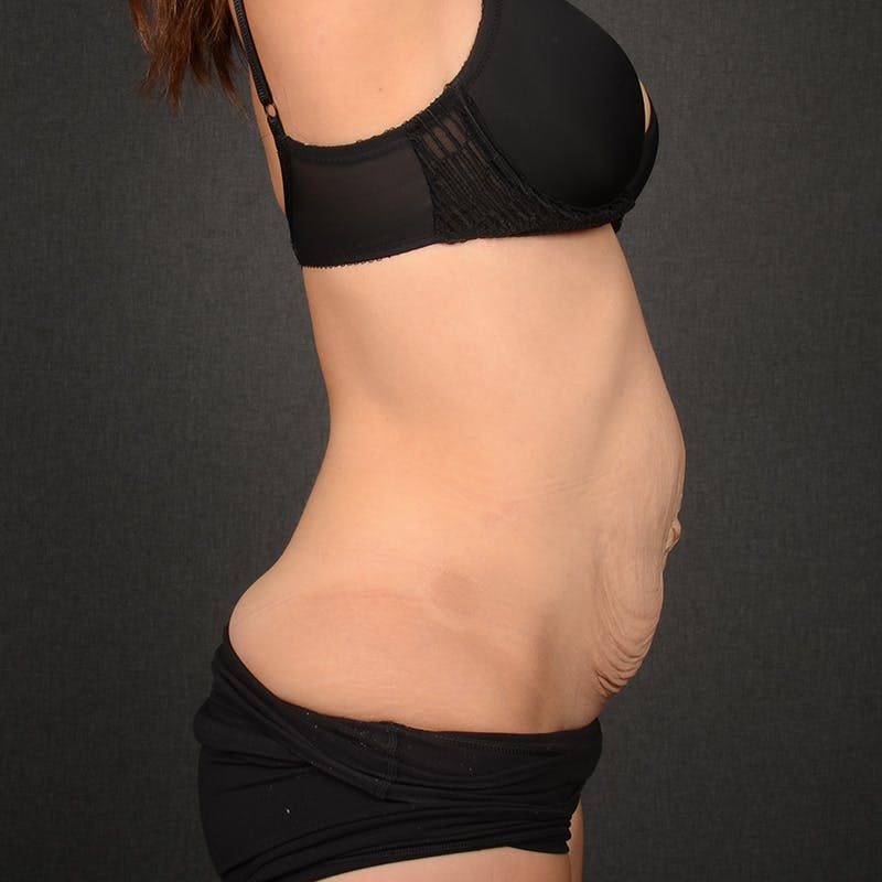 Tummy Tuck Before & After Gallery - Patient 243383 - Image 5