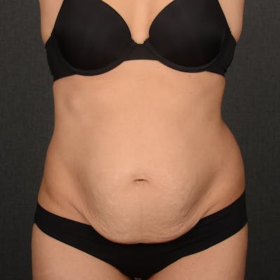 Tummy Tuck Before & After Gallery - Patient 379150 - Image 1