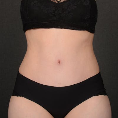 Tummy Tuck Before & After Gallery - Patient 300264 - Image 2