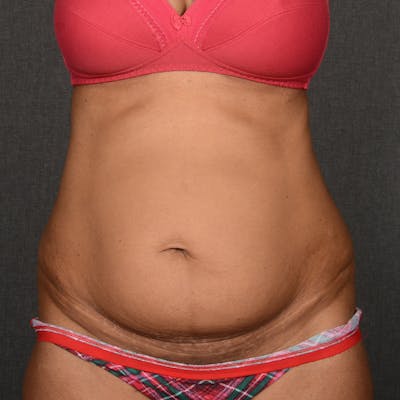 Tummy Tuck Before & After Gallery - Patient 374114 - Image 1
