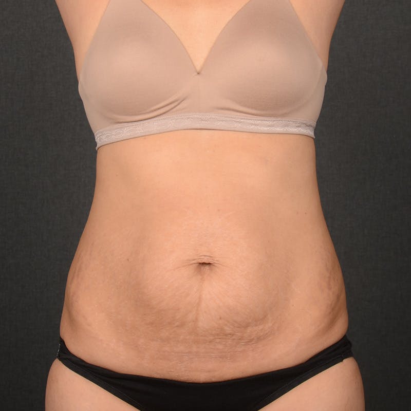 Tummy Tuck Before & After Gallery - Patient 297893 - Image 1