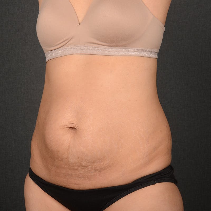 Tummy Tuck Before & After Gallery - Patient 297893 - Image 3