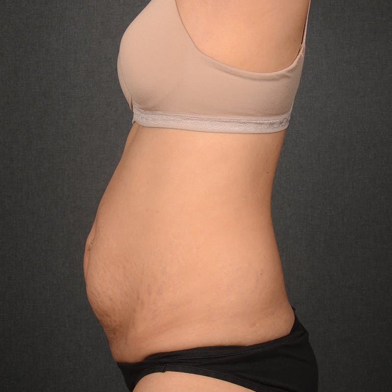 Tummy Tuck Before & After Gallery - Patient 297893 - Image 5