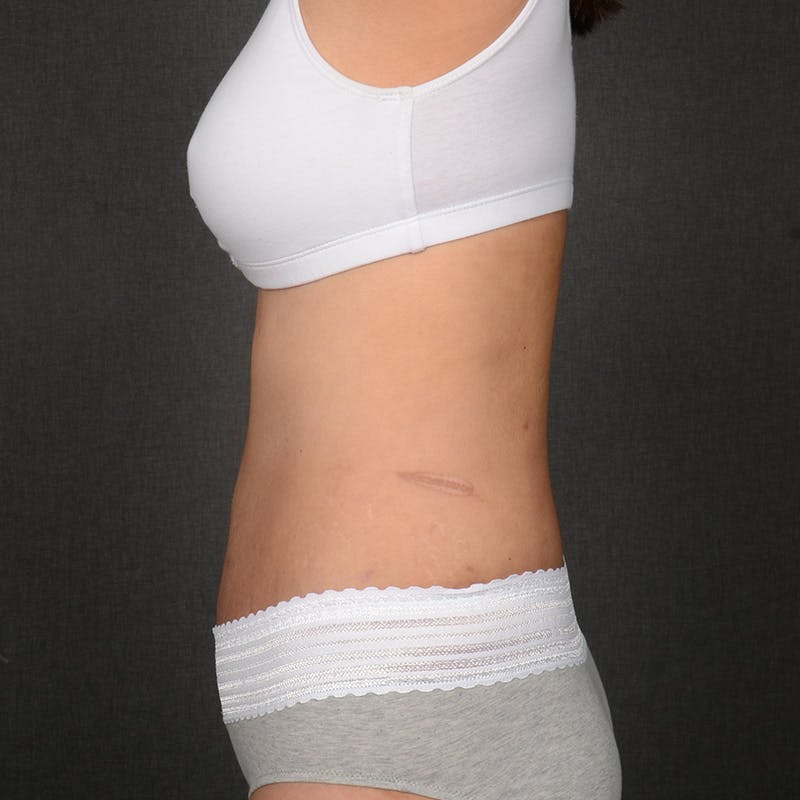 Tummy Tuck Before & After Gallery - Patient 297893 - Image 6