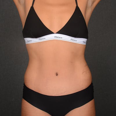 Tummy Tuck Before & After Gallery - Patient 204237 - Image 2