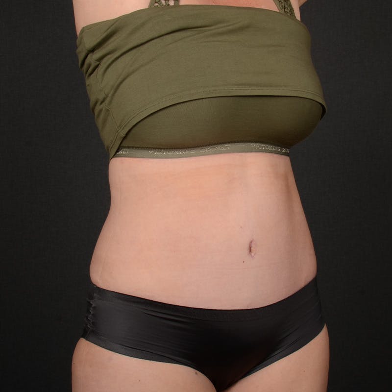 Tummy Tuck Before & After Gallery - Patient 112875 - Image 4