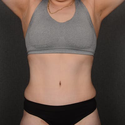 Tummy Tuck Before & After Gallery - Patient 917923 - Image 2