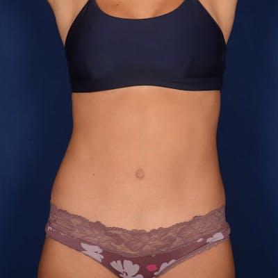 Tummy Tuck Before & After Gallery - Patient 112454 - Image 2