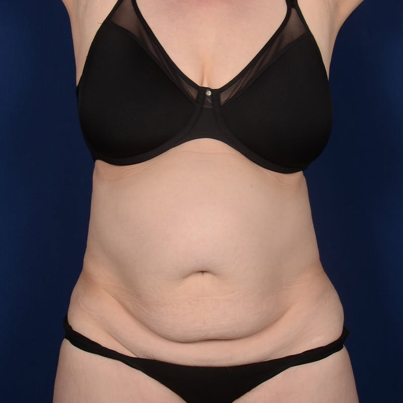 Tummy Tuck Before & After Gallery - Patient 337822 - Image 1