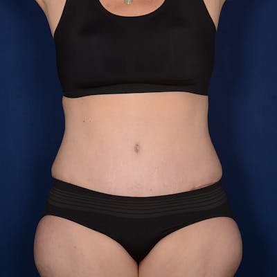Tummy Tuck Before & After Gallery - Patient 120983 - Image 2