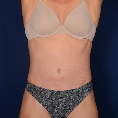 Tummy Tuck Before & After Gallery - Patient 204924 - Image 2