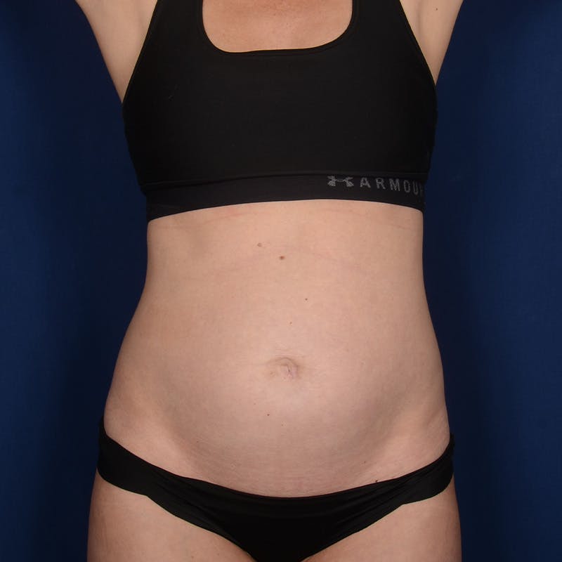 Tummy Tuck Before & After Gallery - Patient 339106 - Image 1