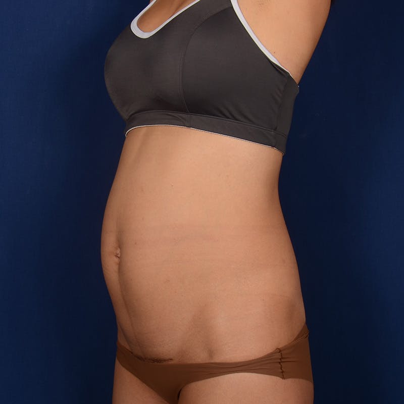 Tummy Tuck Before & After Gallery - Patient 156851 - Image 3