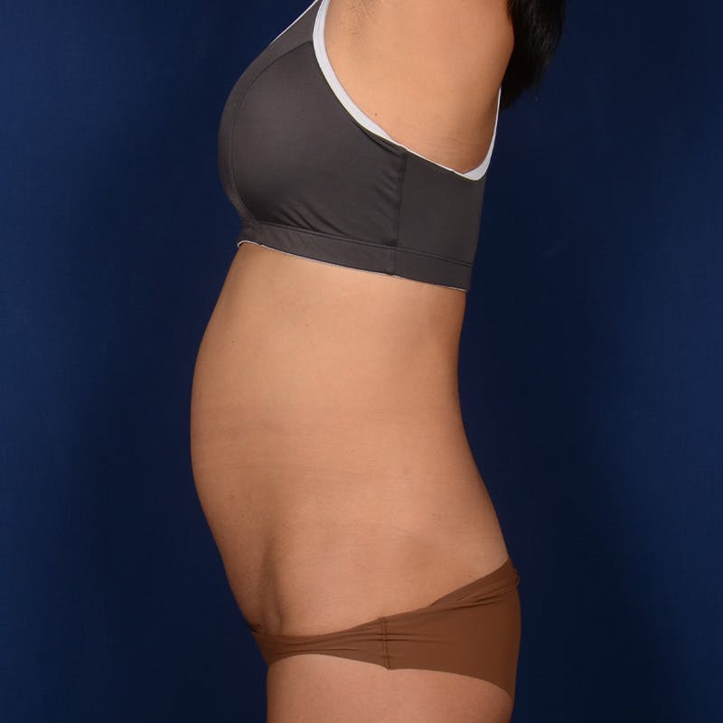 Tummy Tuck Before & After Gallery - Patient 156851 - Image 5