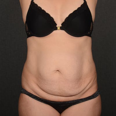 Tummy Tuck Before & After Gallery - Patient 782287 - Image 1