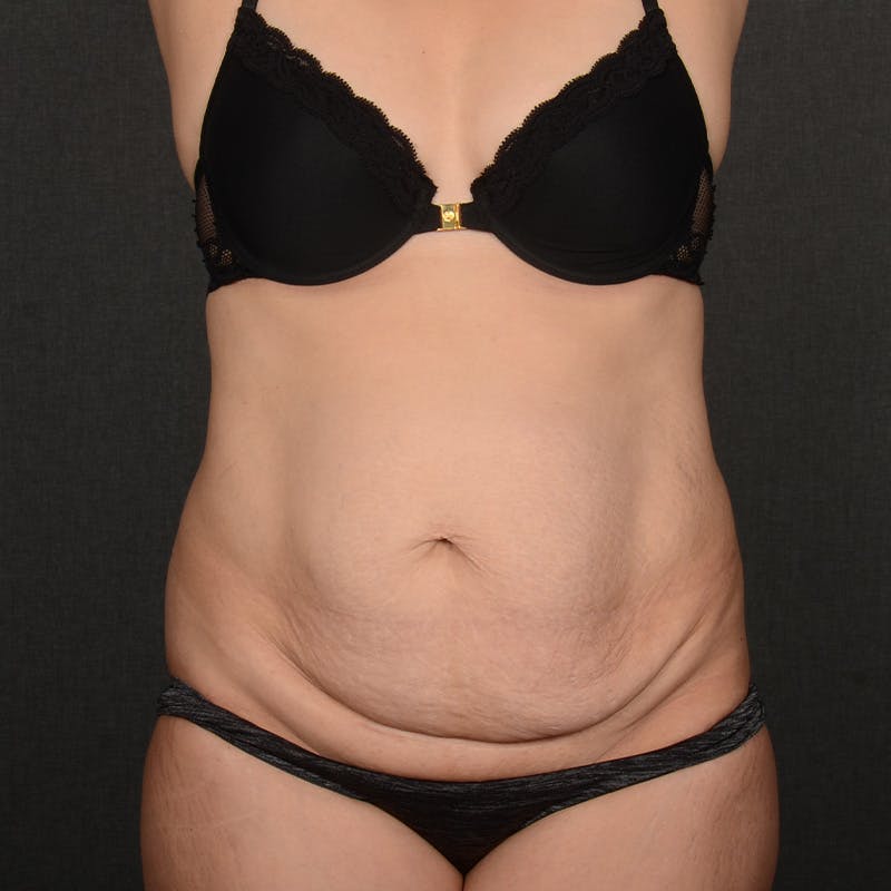 Tummy Tuck Before & After Gallery - Patient 393212 - Image 1