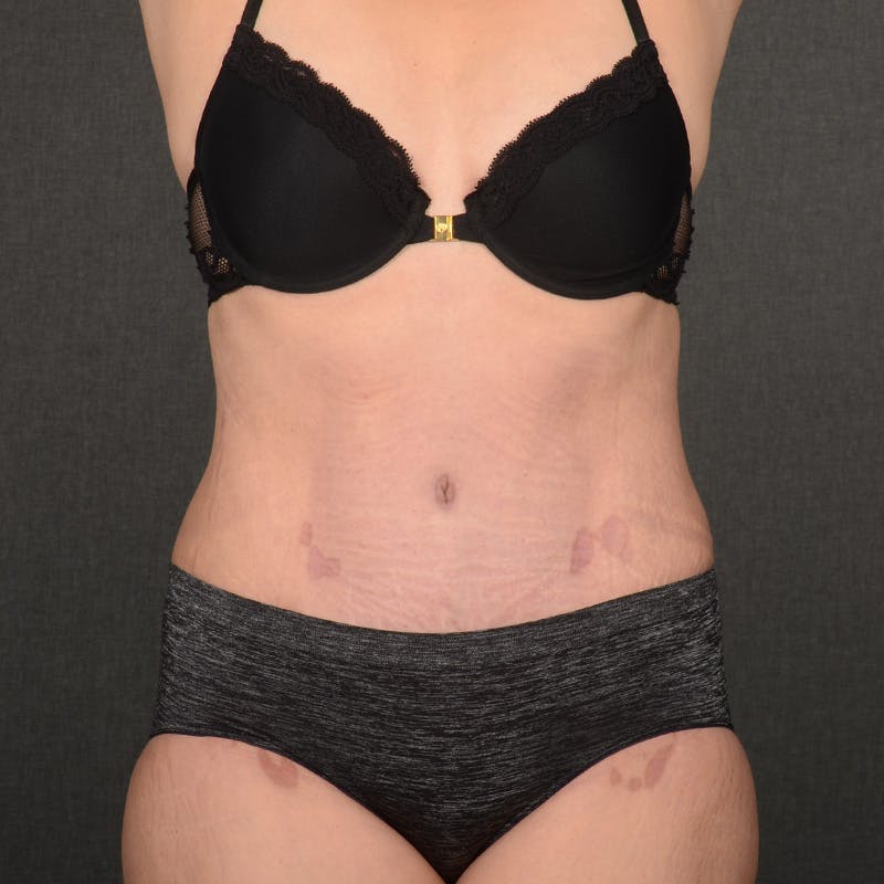Tummy Tuck Before & After Gallery - Patient 393212 - Image 2