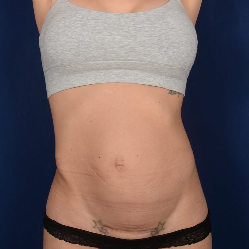 Tummy Tuck Before & After Gallery - Patient 868790 - Image 1