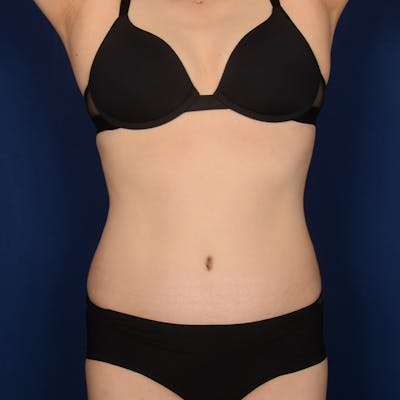 Tummy Tuck Before & After Gallery - Patient 342390 - Image 2