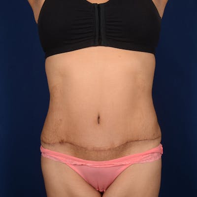 Tummy Tuck Before & After Gallery - Patient 128921 - Image 2