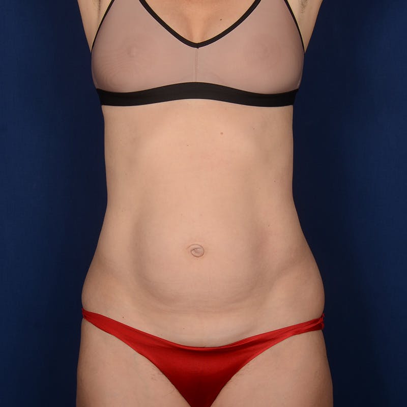 Tummy Tuck Before & After Gallery - Patient 341314 - Image 1