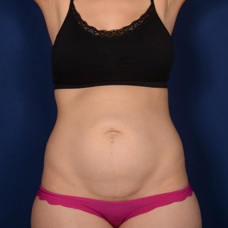 Tummy Tuck Before & After Gallery - Patient 306154 - Image 1