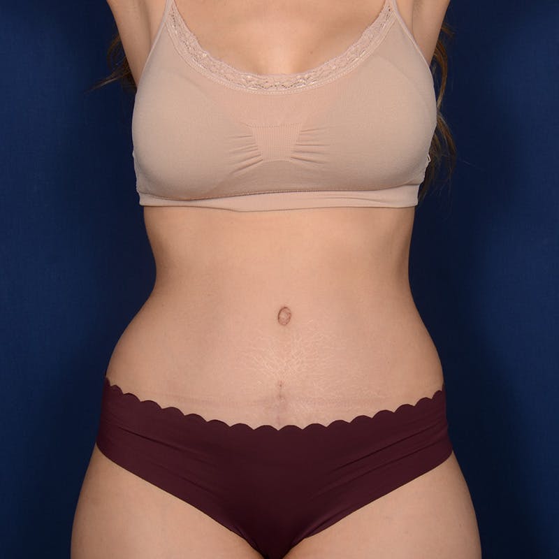 Tummy Tuck Before & After Gallery - Patient 306154 - Image 2