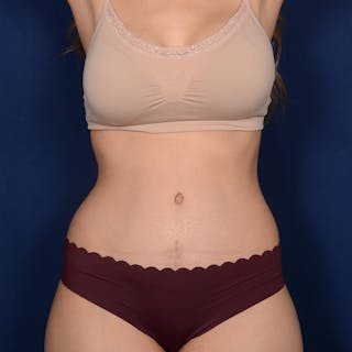 Tummy Tuck Before & After Gallery - Patient 306154 - Image 2