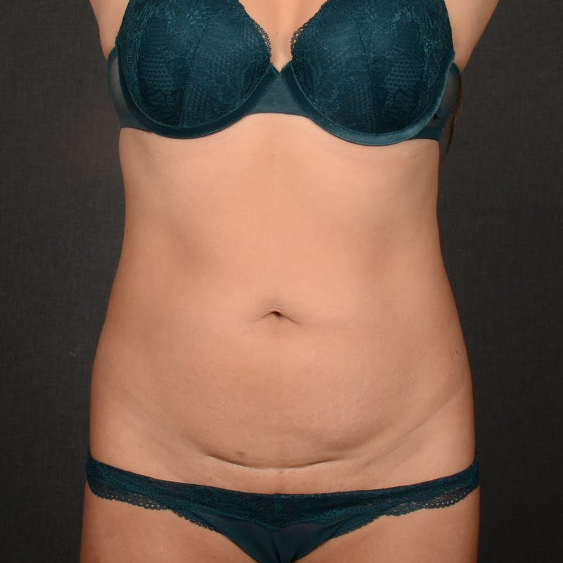 Tummy Tuck Before & After Gallery - Patient 369320 - Image 1