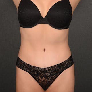 Tummy Tuck Before & After Gallery - Patient 369320 - Image 2