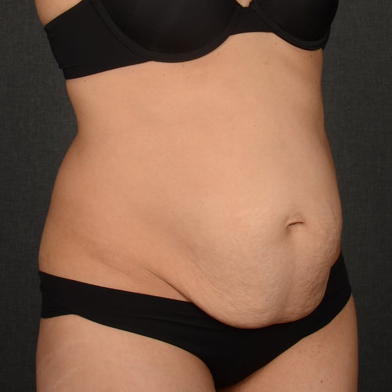 Tummy Tuck Before & After Gallery - Patient 569395 - Image 3