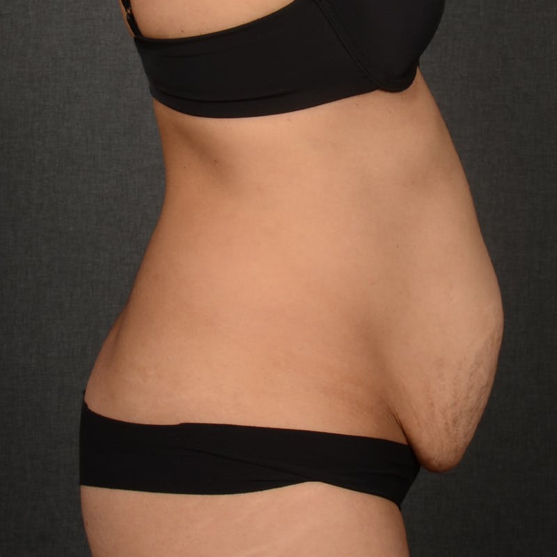 Tummy Tuck Before & After Gallery - Patient 569395 - Image 5