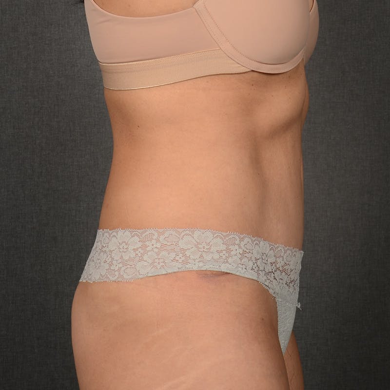 Tummy Tuck Before & After Gallery - Patient 569395 - Image 6